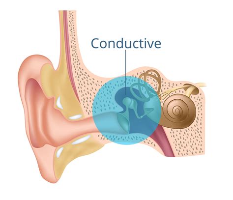 conductive hearing loss